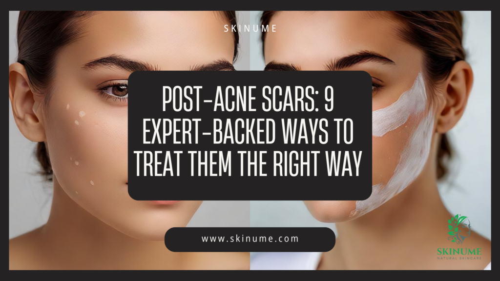 Post-Acne Scars: 9 Expert-Backed Ways to Treat Them the Right Way
