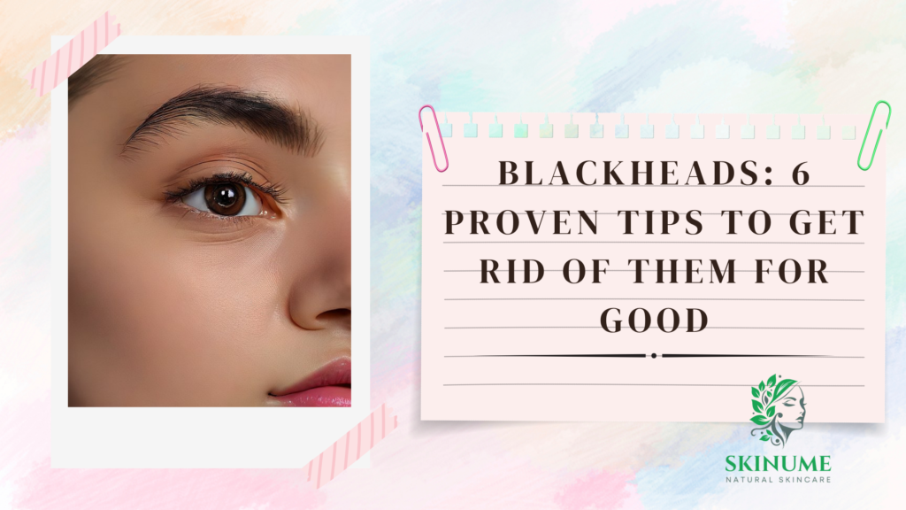 Blackheads: 6 Proven Tips to Get Rid of Them for Good